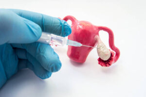 PCOS and IVF